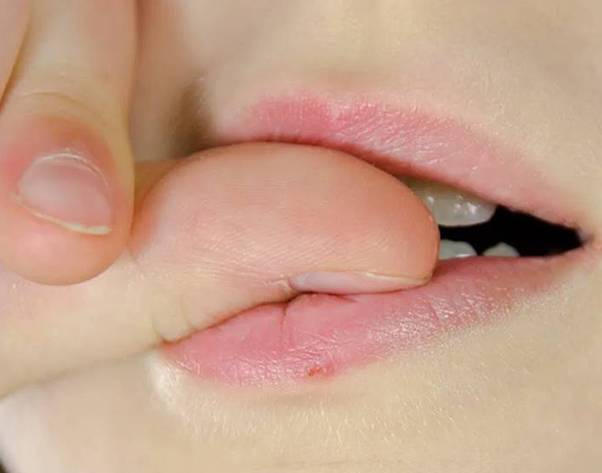 Deri Yolma Bozukluğu (Ekskoriasyon)